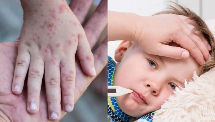 Kızamık ve boğmacaya karşı uzmanlar uyarıyor: Olaylar artıyor, önlemleri almak gerekiyor